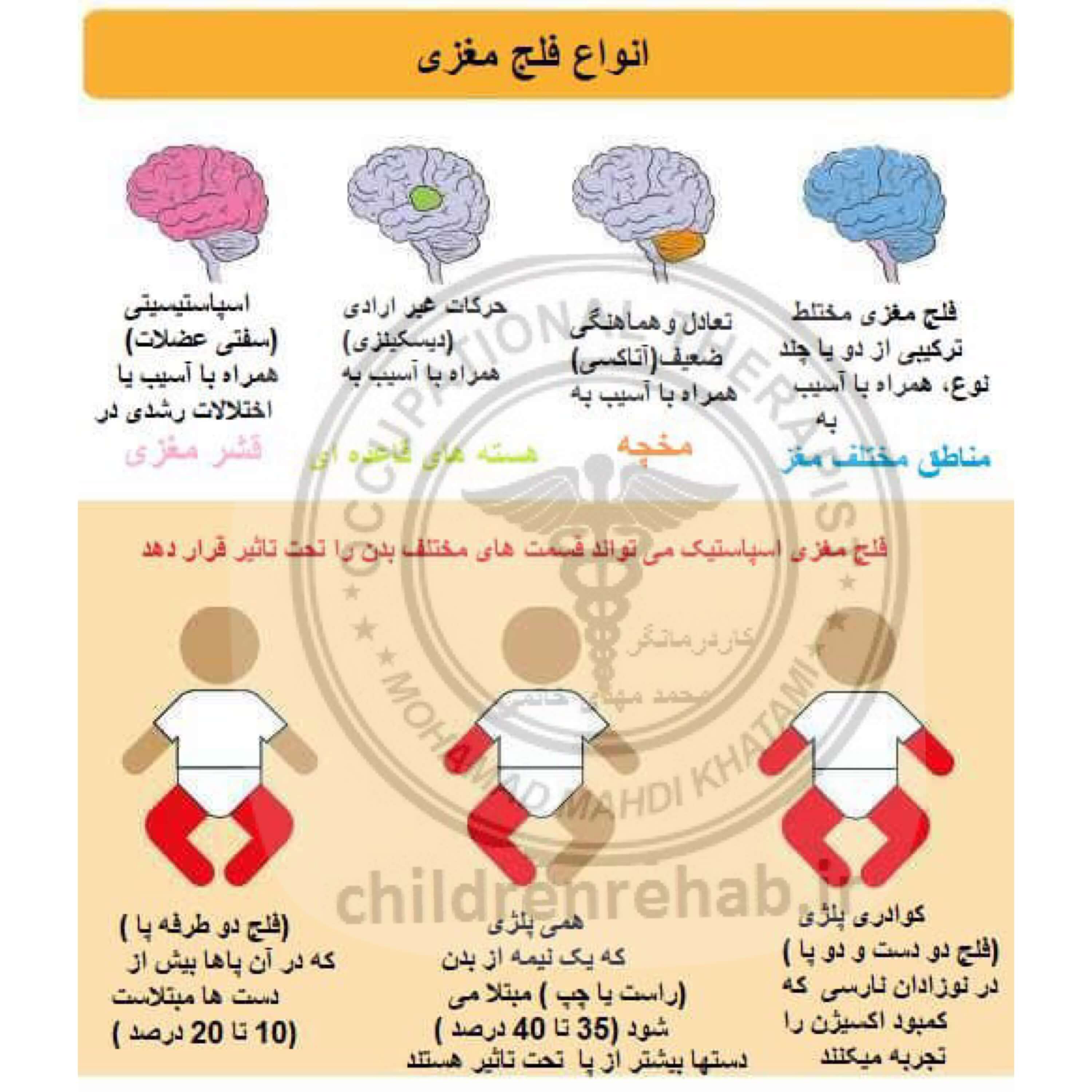 کاردرمانی در کودکان فلج مغزی-افلج مغزی